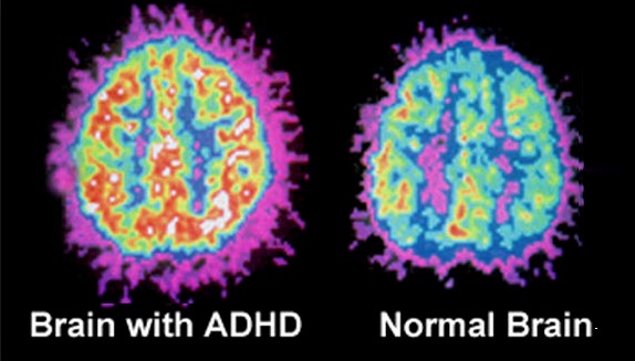 Skany PET mózgu: po lewej mózg z ADHD (intensywniejsze kolory), po prawej mózg bez ADHD — widoczna różnica w aktywności metabolicznej